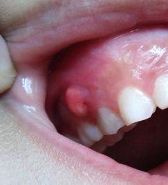 舌头溃疡可以吃凉瓜,缓解舌头溃疡困扰