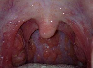 吃瓜喉咙长泡,揭秘夏日常见病症的成因与防治